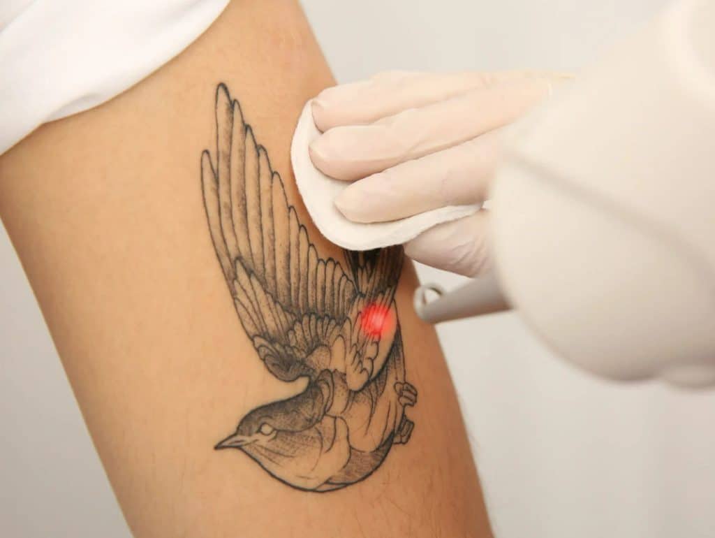 laser tattoo removal expectations