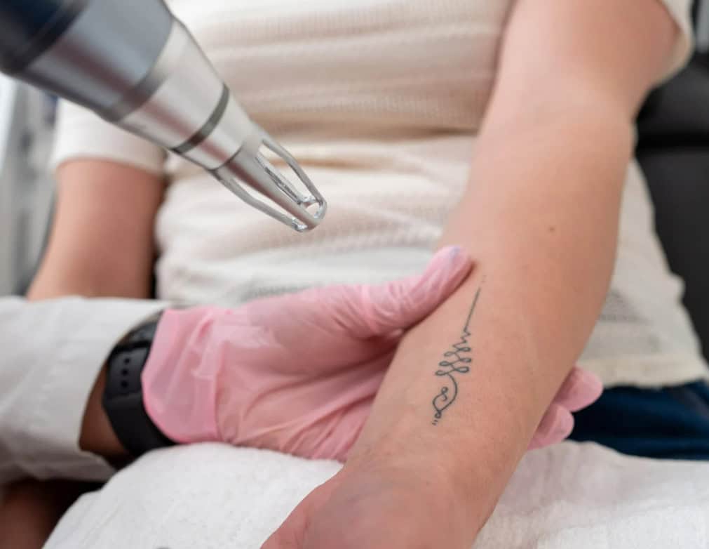 laser tattoo removal guide